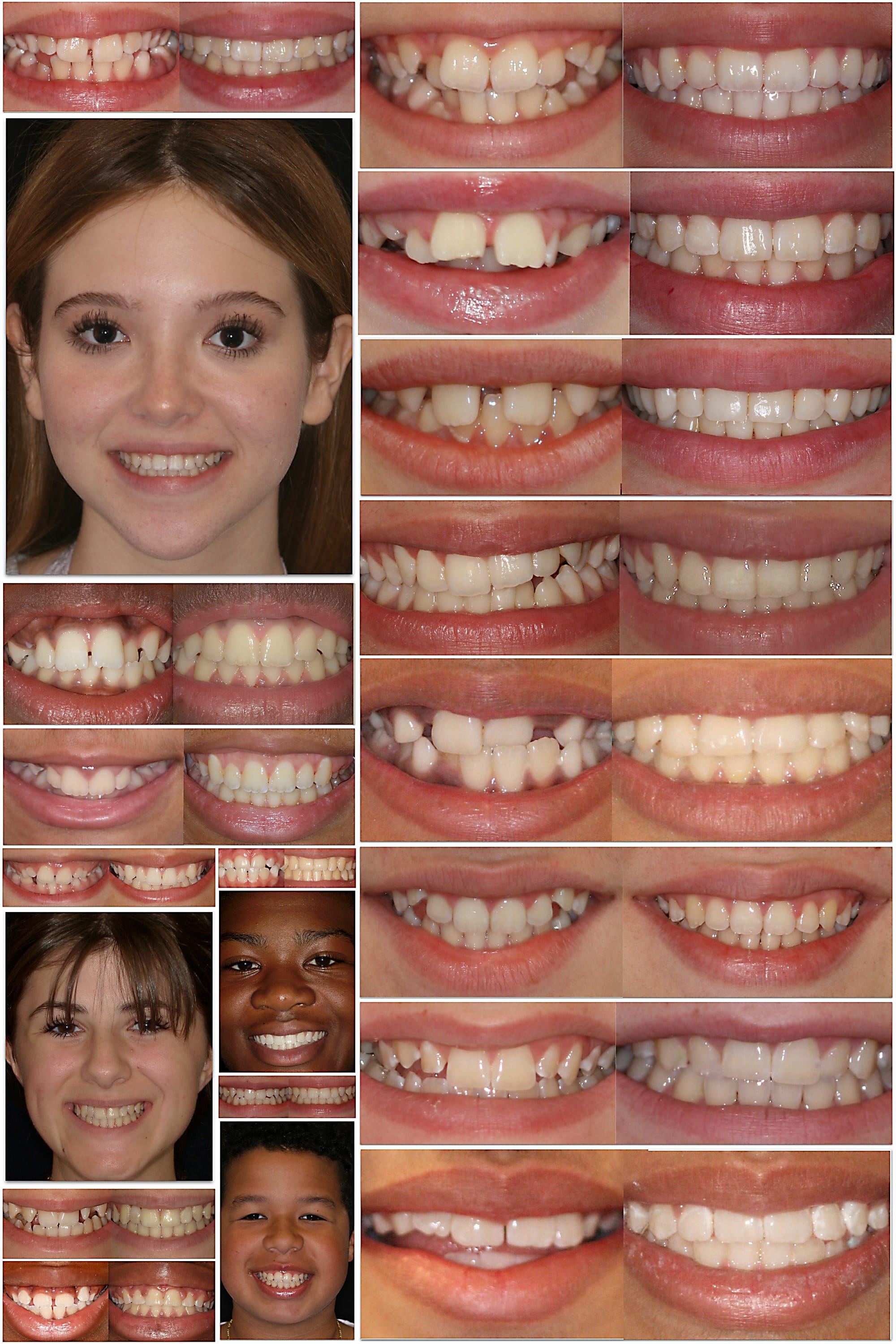 A collage of Dr. Zahedi's orthodontic patients before and after treatment with braces.