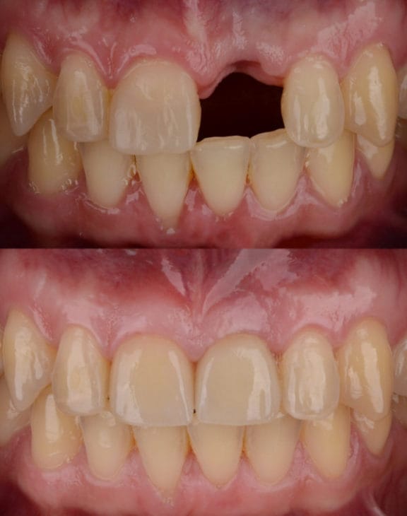 Implant planning at Azari & Zahedi Dentistry