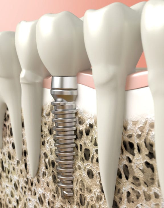 Cross-section of a dental implant showing titanium root, abutment, and crown