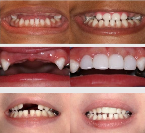 Pediatric partial denture for replacing missing front teeth