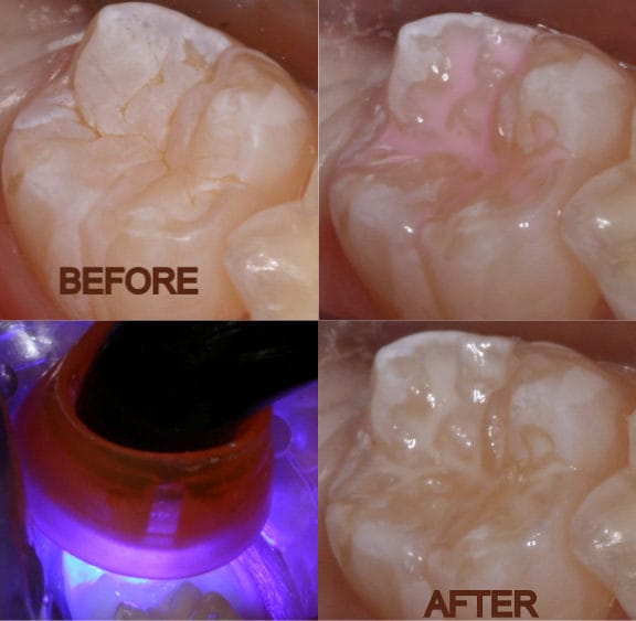 Finished dental sealant protecting a child