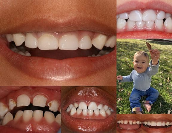 Strip crown restoration on primary incisors before and after