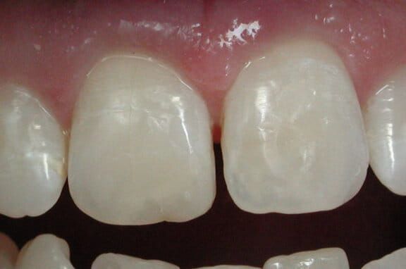 Before and after dental bonding to repair a chipped tooth After