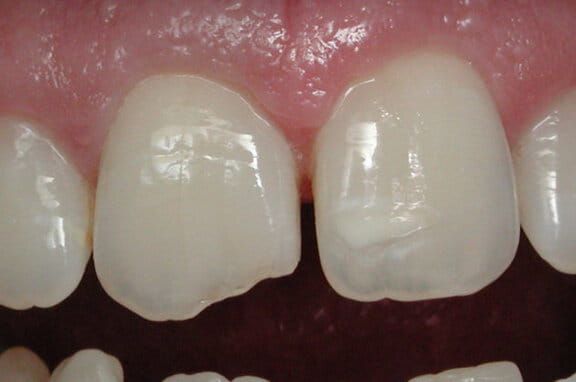 Before and after dental bonding to repair a chipped tooth Before