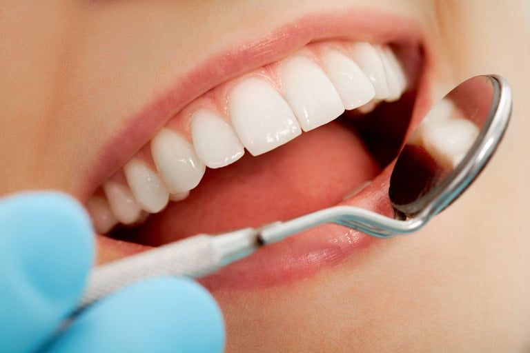 Dental bonding result close-up